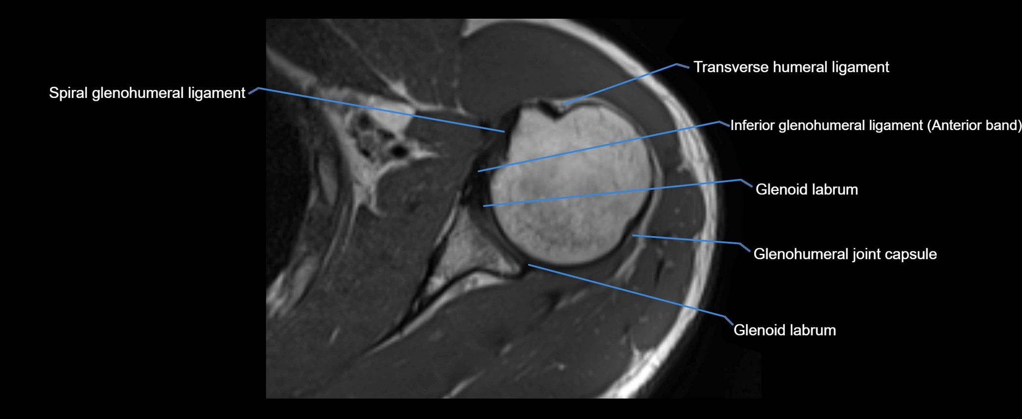 shoulder ligaments axial 3d 3t mri image-img-00005-00068.webp